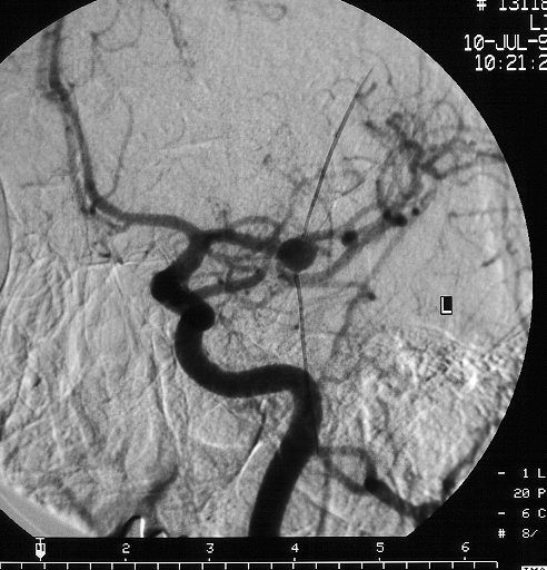 aneurysm definition. Aneurysm Prevention