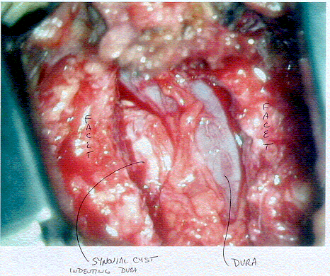 Facet Synovial Cyst